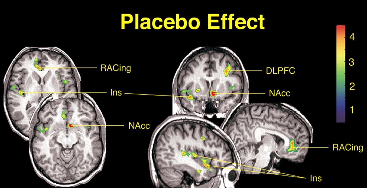 تصویر گرافیکی مغز با نواحی فعال شده تحت اثر پدیده پلاسیبو، نشاندهنده واکنش مغز به باور ذهنی