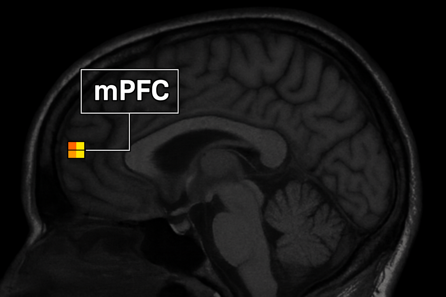 تصویری از mpfc و mri مغز